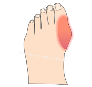 痛風の人の腫れた足の指