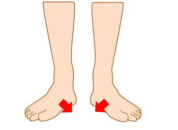 足の内側に体重がかかる扁平足の足