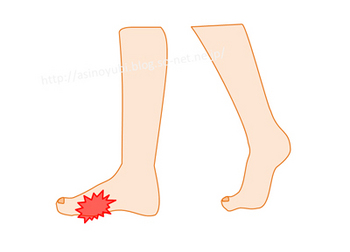 種子骨炎で痛む足の位置