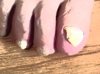 爪白癬になった人の足の爪