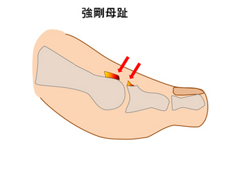 強剛母趾の足指の状態