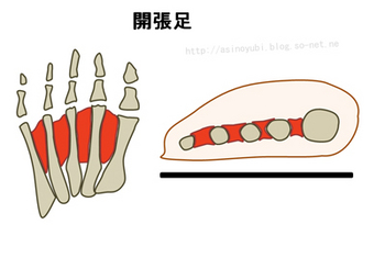 外反母趾（開張足）になる人の足の構造